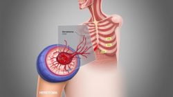 Hematoma: Penyebab, Gejala, dan Penanganannya