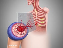 Hematoma: Penyebab, Gejala, dan Penanganannya